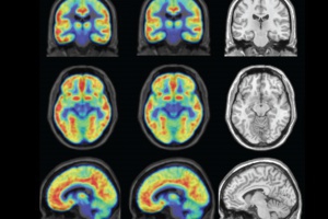 Revierten el Parkinson en ratones reemplazando neuronas